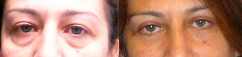 Before and after lower blepharoplasty showing removal of under-eye bags and refreshed eyelid appearance