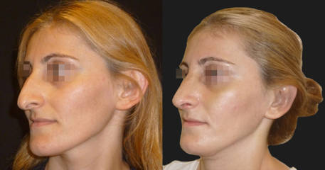 Before and after side profile rhinoplasty showing correction of dorsal hump and refined nasal tip
