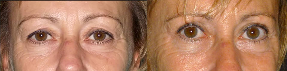 Before and after blepharoplasty showing reduced under-eye bags and smoother skin around the eyes