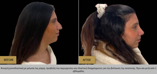 Side view before and after open rhinoplasty showing correction of dorsal hump and refined nasal profile