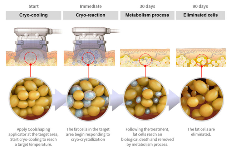 Κρυολιπόλυση και ενέσιμη λιπόλυση