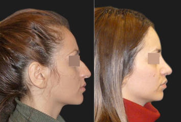 Female side profile before and after rhinoplasty, correcting dorsal hump and refining nasal tip for a more balanced profile