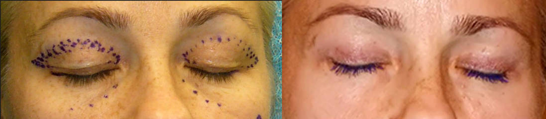 Before and after upper blepharoplasty with surgical markings showing eyelid lift and smoother upper eyelid contour