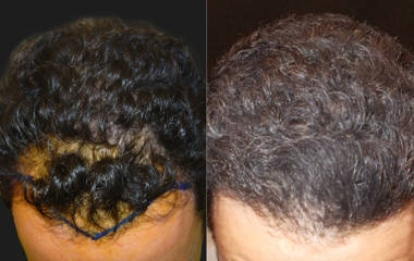 Before and after male hair transplantation showing frontal hairline restoration and increased scalp density
