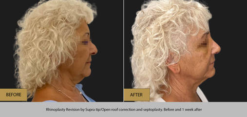 Profile view of woman before and after revision rhinoplasty with supra tip and septum correction