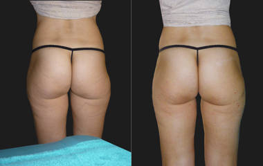 Before and after mesotherapy lipolysis of the buttocks showing reduced fat volume and smoother contour