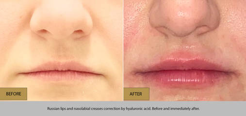 Before and after Russian lips and nasolabial creases correction by hyaluronic acid