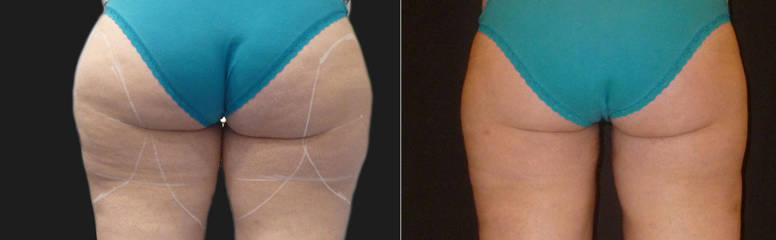 Before and after thigh and buttock liposuction showing smoother skin and improved lower body contour 