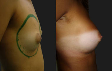 Side view before and after breast augmentation with silicone implants showing natural projection and lifted appearance