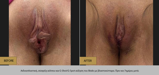 Before and after vaginal tightening and rejuvenation using laser and PRP