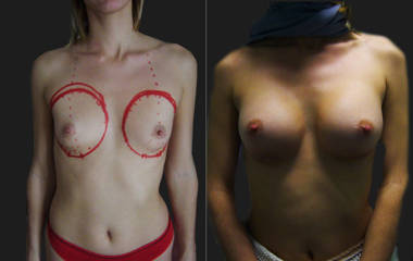 Breast augmentation with silicone implants showing natural enhancement and improved chest symmetry