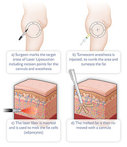 Diode Laser Therapy