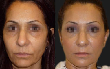 Before and after facial implant surgery showing enhanced cheekbone and balanced lower face contour