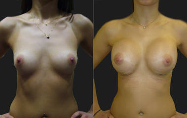 Before and after breast augmentation with silicone implants showing fuller contour 