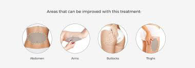 Θεραπεία υπερήχων με HifU