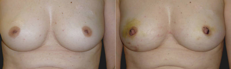 Before and after breast lift surgery showing early post-operative healing and improved breast contour