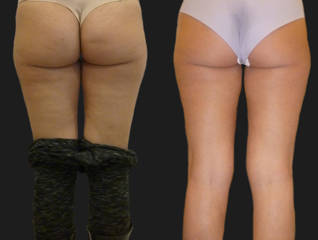 Before and after mesotherapy lipolysis on the buttocks showing improved smoothness and reduced fat