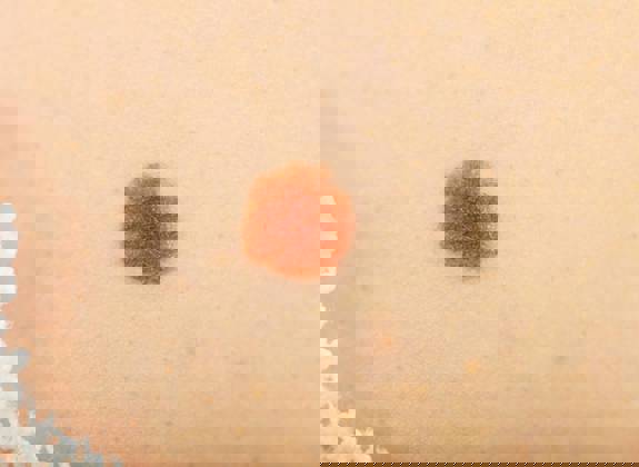 Close up of a brown mole on light skin, used to illustrate skin examination of early signs of skin cancer