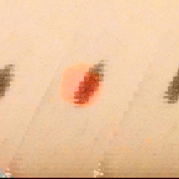 Close up of a brown mole on light skin, used to illustrate skin examination of early signs of skin cancer