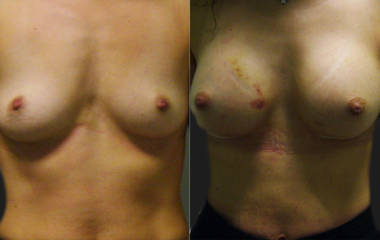 Before and after breast augmentation showing fuller contour and enhanced symmetry with silicone implants