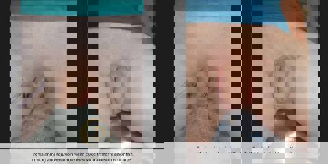 Before and after penile thickening and rejuvenation with stem cell and 40cc fat transfer