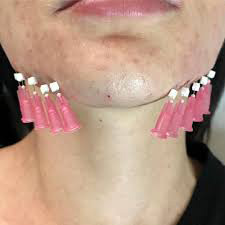 Face lift με νήματα