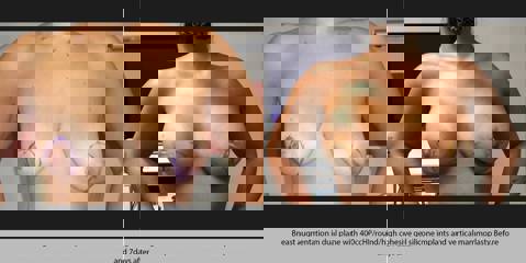 Before and after breast lift and augmentation with 400cc high profile implant showing enhanced volume and lifted shape