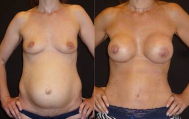 Before and after Mommy Makeover showing abdominal tightening and breast augmentation for body restoration