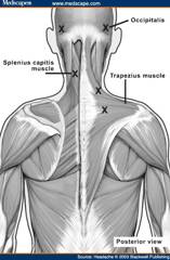 Illustrated diagram showing typical injection points for botulinum toxin treatment on back muscles