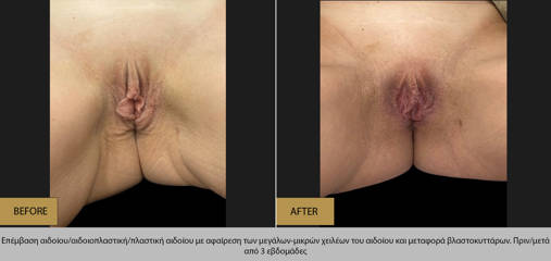 Before and after combined labiaplasty and vaginal tightening showing improved vulvar contour