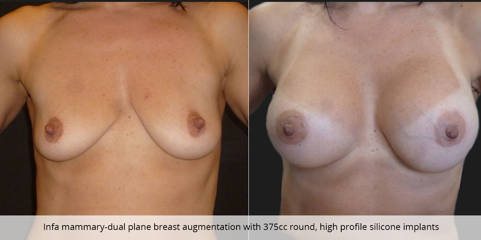 Before and after infa mammary-dual breast augmentation with 375cc round, high profile silicone implants