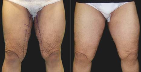 Before and after inner thigh lift showing tightened inner thigh contour and smoother skin