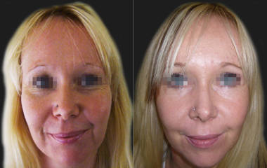 Before and after blepharoplasty showing smoother eyelids and rejuvenated facial appearance with reduced wrinkles