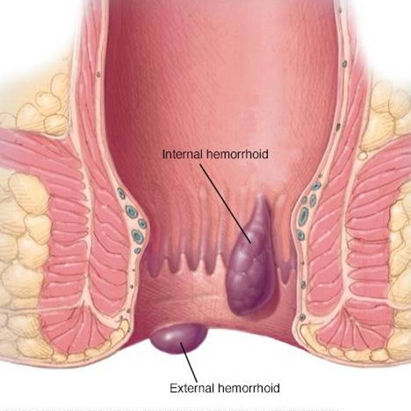 Illustration showing internal and external hemorrhoids in the anal canal, highlighting their structure