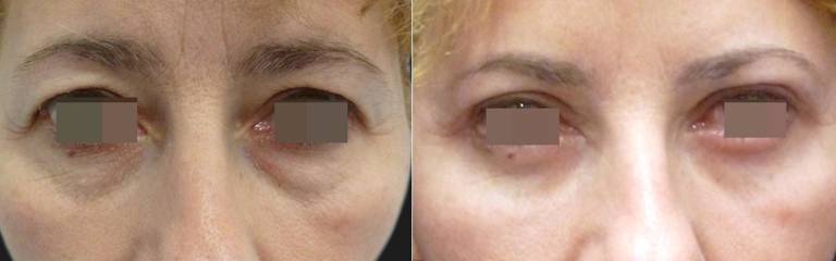 before and after lower blepharoplasty showing reduced puffiness and smoother under-eye contours
