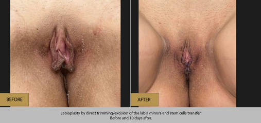 Labiaplasty by direct trimming/ excision of the labia minora and stem cells transfer, before and 10 days after