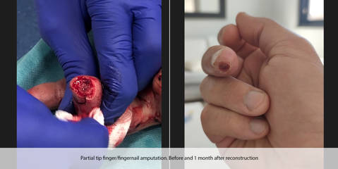Before and after of partial fingertip and nail amputation, showing the injured finger and one month after reconstructive healing