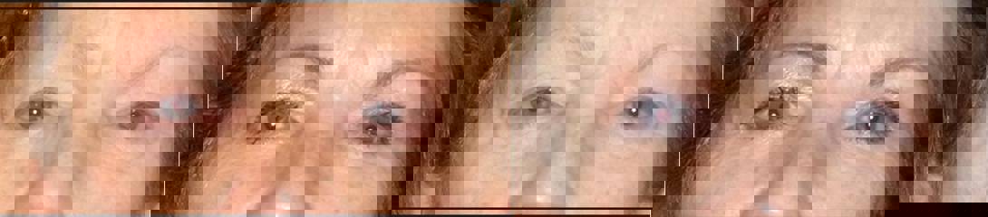 Before and after upper blepharoplasty showing improved eyelid contour and more open, youthful eyes