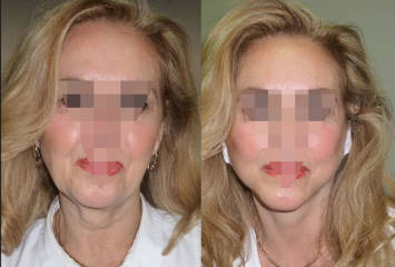 Before and after facelift showing smoother jawline and refined neck contour