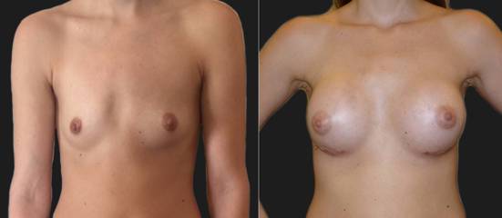 Before and after breast augmentation showing increased fullness and improved symmetry with silicone implants