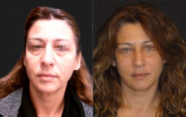 Before and after lower blepharoplasty showing reduction of under-eye puffiness and smoother eyelid contour