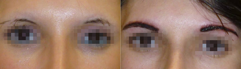 Before and after eyebrow micropigmentation showing carefully applied pigment for natural and enhanced brow architecture