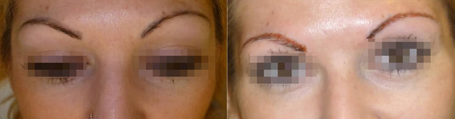 Before and after eyebrows micropigmentation showing refined shape and enhanced brow definition