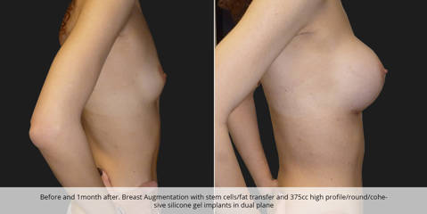 Before and 1 month after breast augmentation with stem cells and fat transfer and 375cc silicone gel implant