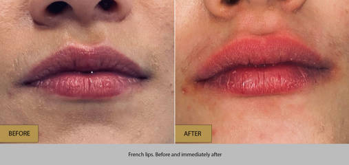 Before and immediately after French lips treatment