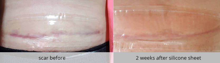 Before and after comparison of scar treatment showing improvement after two weeks 