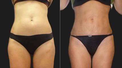Before and after comparison of a woman's abdomen showing slimmer contours following liposuction