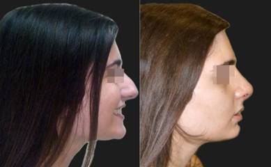 Female patient side view before and after rhinoplasty showing corrected nasal hump and refined nose tip