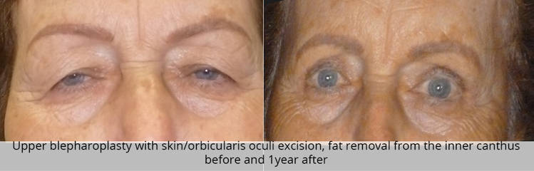 Before and one year after upper blepharoplasty and inner fat removal showing natural eye contour