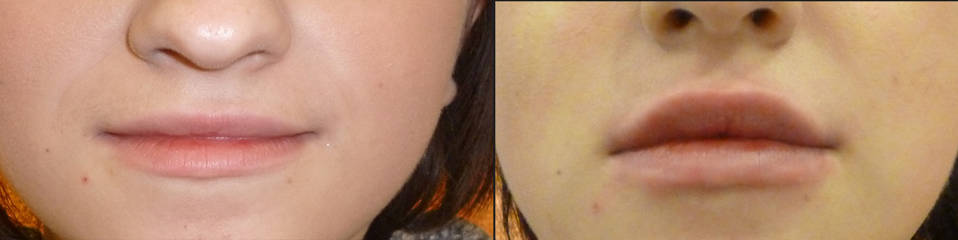 Before and after lip filler treatment showing enhanced lip volume and refined border